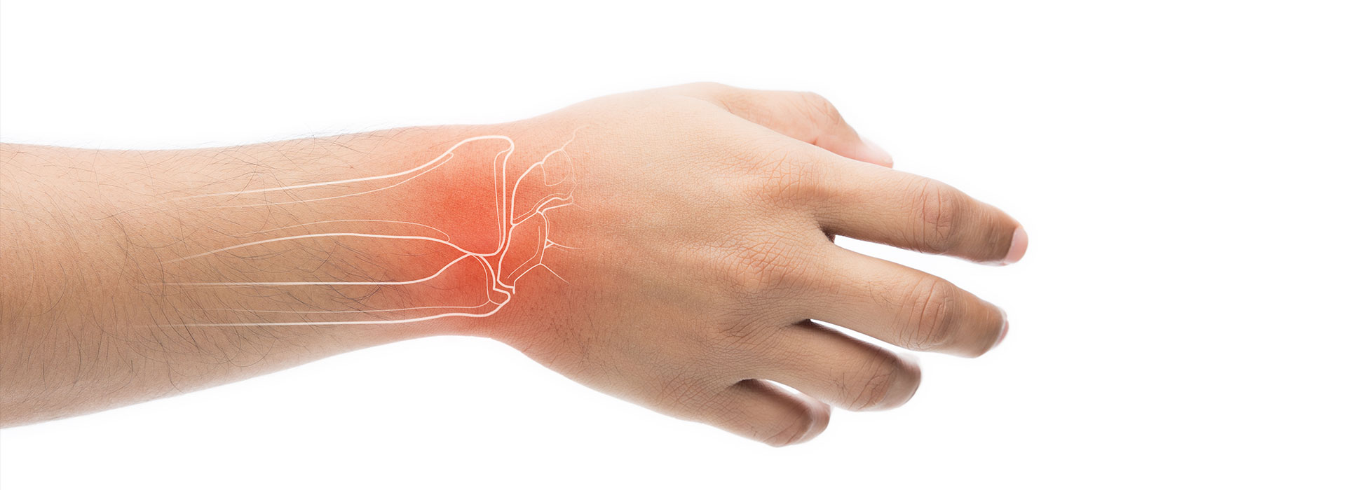 🥇 Carpal Tunnel Treatment  Symptoms of Carpal Tunnel Syndrome