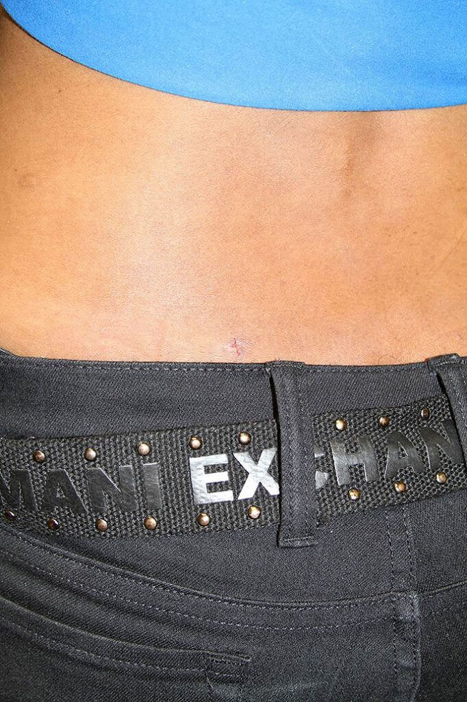 Endoscopic Discectomy Minimally Invasive Herniated Disc Treatment, Relief