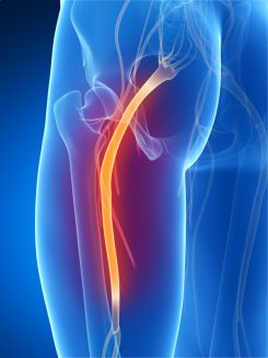 Sciatic Nerve Pain Treatments in Atlanta