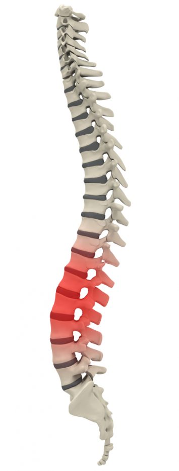 Herniated Disc - When Should You See an Orthopedic Surgeon? : Elite Sports  Medicine + Orthopedics: Orthopedics